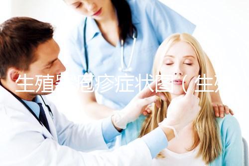 生殖器皰疹癥狀圖（生殖皰疹的圖案大全）