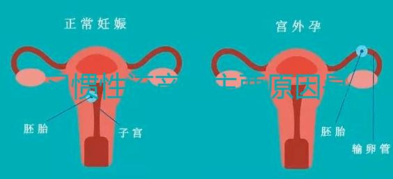 習慣性流產的主要原因是什么?