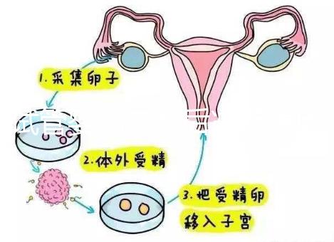 試管嬰兒二超后減藥原因已找到，對胎兒沒影響別瞎擔心